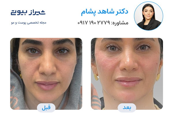 مادلینگ صورت در شیراز - دکتر شاهد پشام