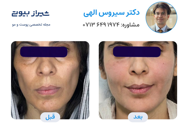 مادلینگ صورت در شیراز - دکتر سیروس الهی