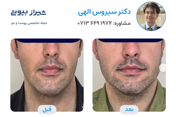 مادلینگ صورت در شیراز - دکتر سیروس الهی