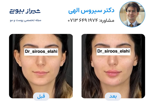 مادلینگ صورت در شیراز - دکتر سیروس الهی