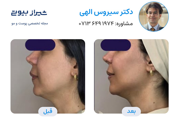 مادلینگ صورت در شیراز - دکتر سیروس الهی