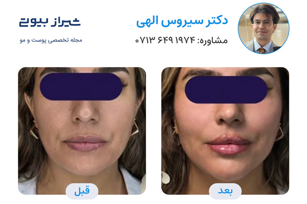 مادلینگ صورت در شیراز - دکتر سیروس الهی