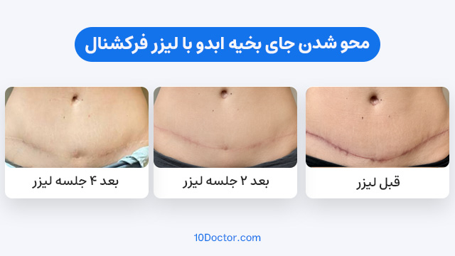 محو شدن جای بخیه ابدو با لیزر فرکشنال
