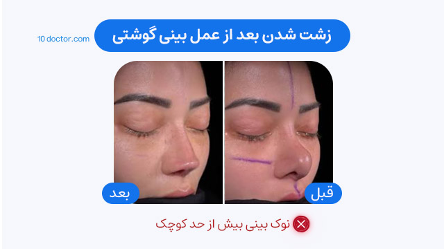 زشت شدن بعد از عمل بینی گوشتی