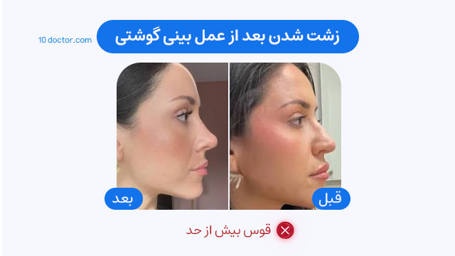 زشت شدن بعد از عمل بینی استخوانی