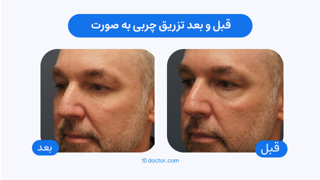 قبل و بعد تزریق چربی به صورت (در مردان)