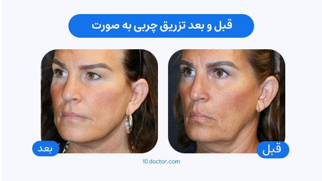 قبل و بعد تزریق چربی به صورت (در زنان)