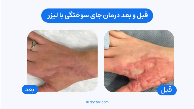 قبل و بعد درمان جای سوختگی با لیزر