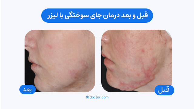 قبل و بعد درمان جای سوختگی با لیزر