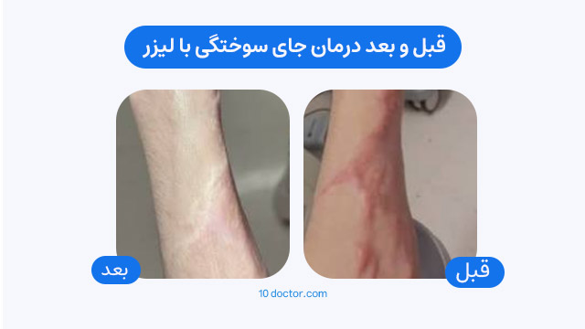قبل و بعد درمان جای سوختگی با لیزر
