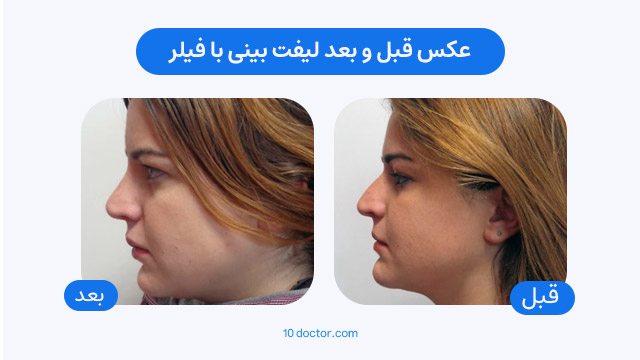عکس قبل و بعد لیفت بینی با فیلر