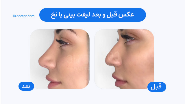عکس قبل و بعد لیفت بینی با نخ