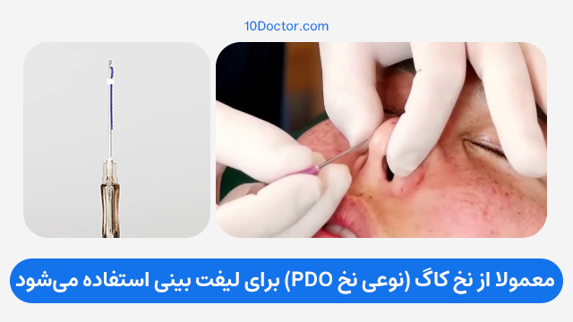 معمولا از نخ کاگ (نوعی نخ PDO) برای لیفت بینی استفاده می‌شود.