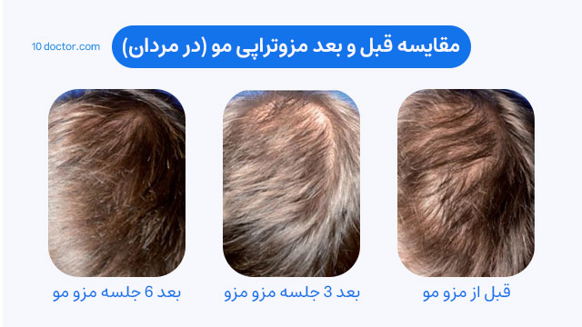مقایسه قبل و بعد مزوتراپی مو (در مردان)