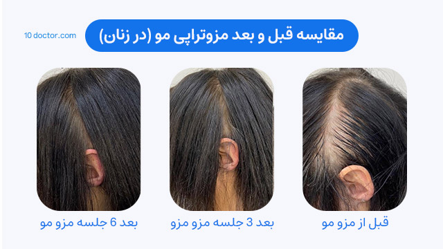 مقایسه قبل و بعد مزوتراپی مو (در زنان)