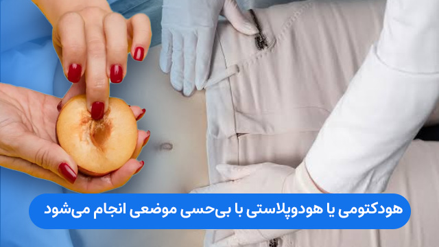 هودکتومی یا هودوپلاستی با بیحسی موضعی انجام میشود.