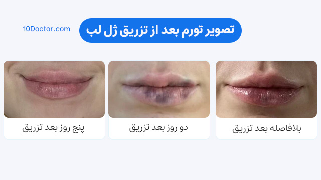 تصویر کبودی بعد از تزریق ژل لب
