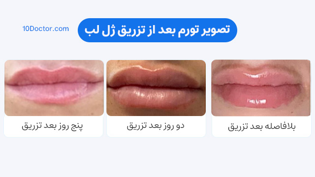 تصویر تورم بعد از تزریق ژل لب
