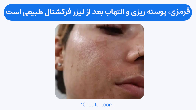 قرمزی، پوسته ریزی و التهاب بعد از لیزر فرکشنال طبیعی است.