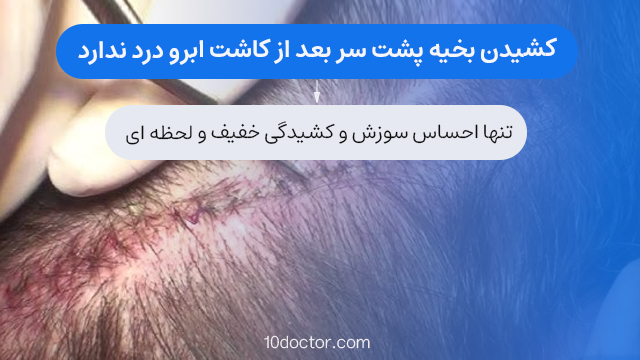 کشیدن بخیه پشت سر بعد از کاشت ابرو درد ندارد.