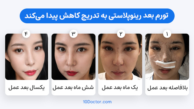 تورم بعد رینوپلاستی به تدریج کاهش پیدا میکند.