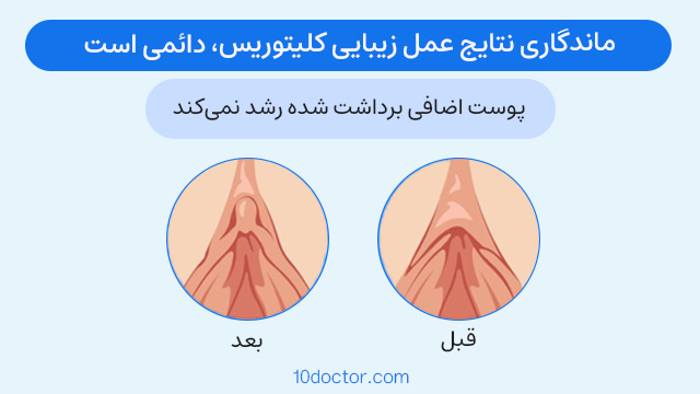 ماندگاری نتایج عمل زیبایی کلیتوریس، دائمی است و پوست اضافی برداشت شده رشد نمیکند.