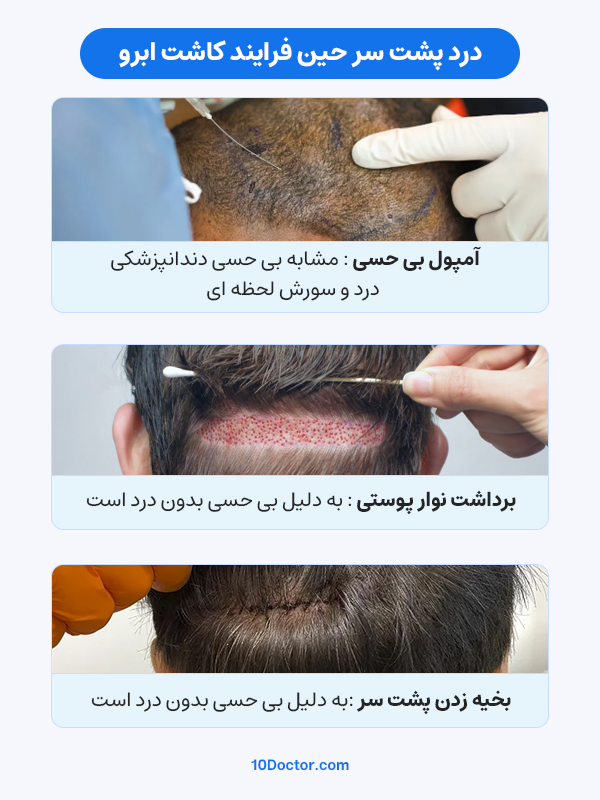 درد پشت سر حین فرایند کاشت ابرو