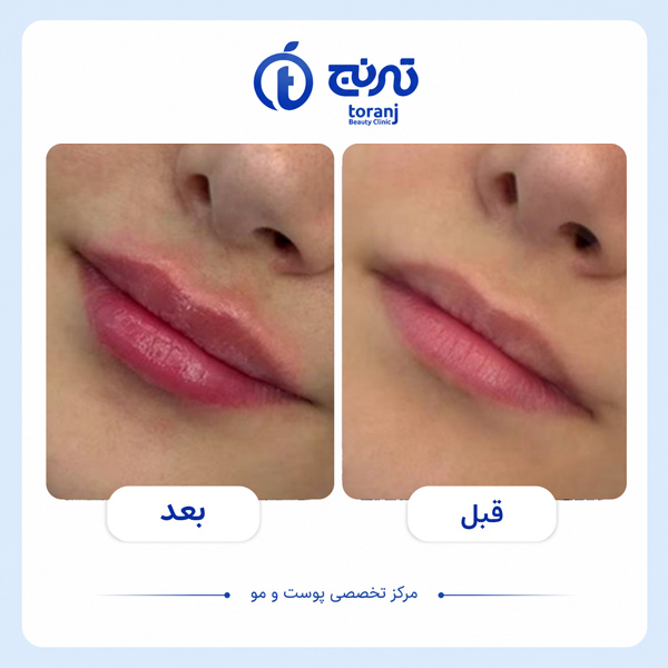 before after clinic toranj 1