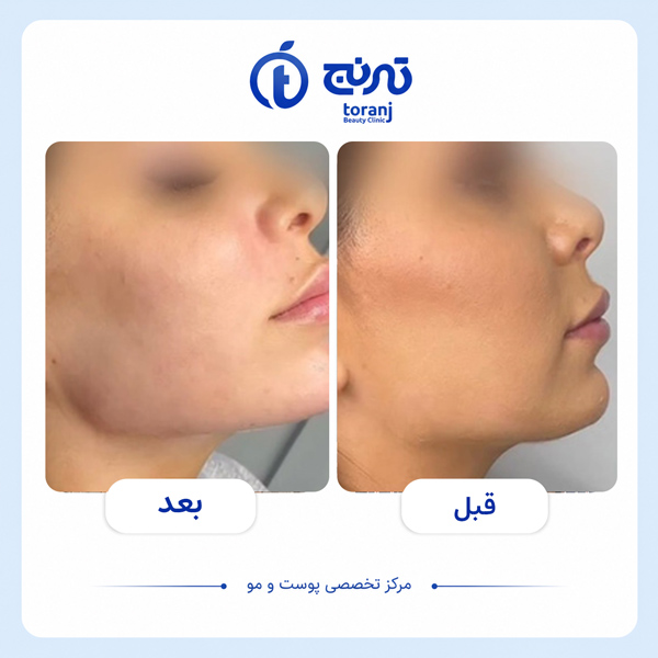 before after clinic toranj 11
