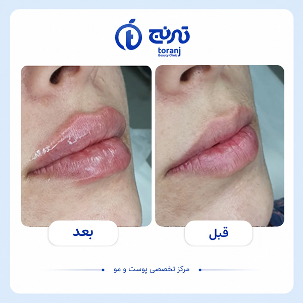 before after clinic toranj 13