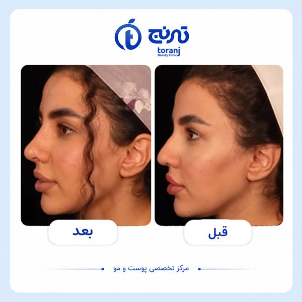 before after clinic toranj 14