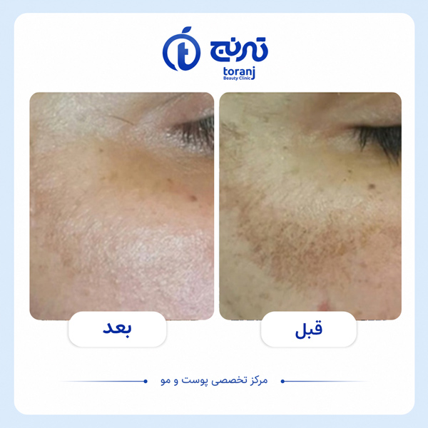 before after clinic toranj 15