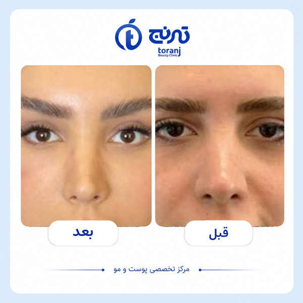 before after clinic toranj 2
