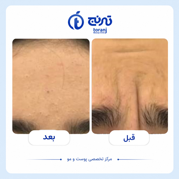 before after clinic toranj 3