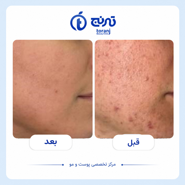 before after clinic toranj 4