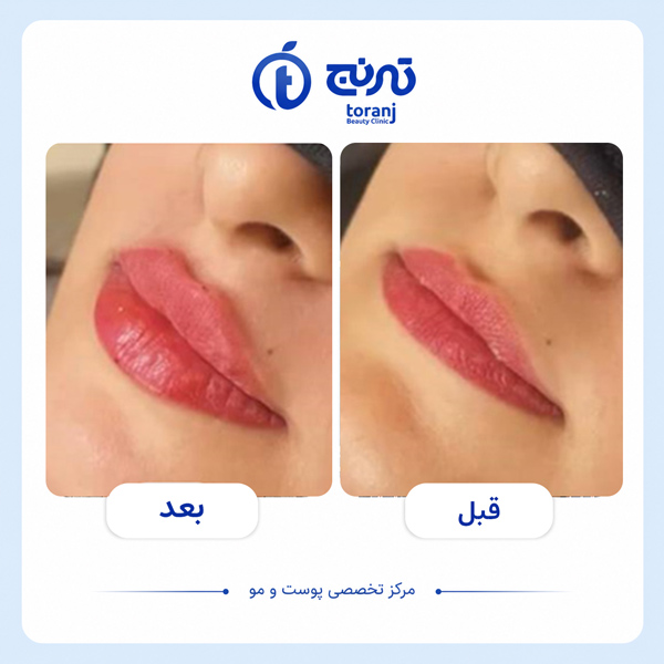 before after clinic toranj 5