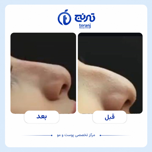 before after clinic toranj 6
