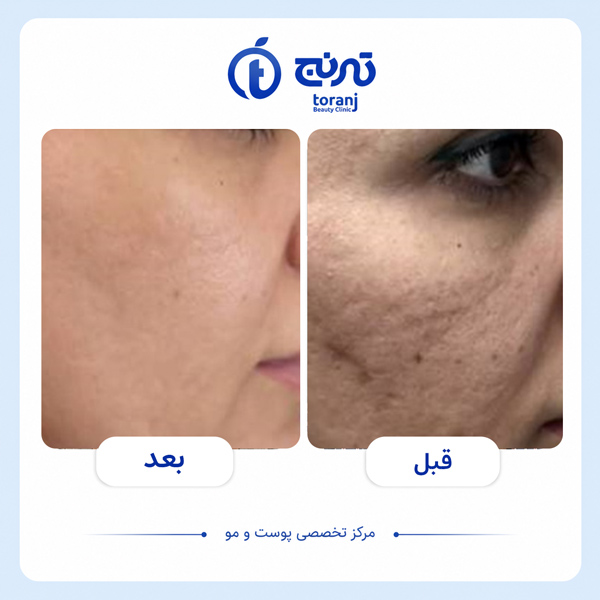 before after clinic toranj 9