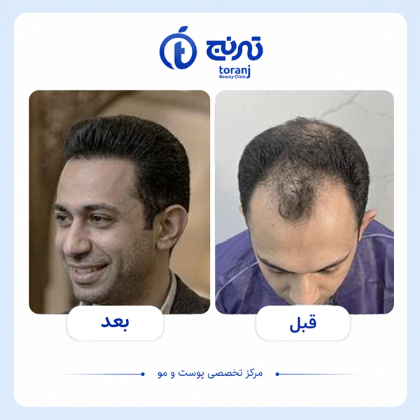 before after hair transplant clinic toranj 1