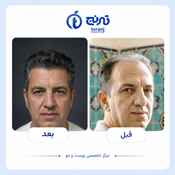 before after hair transplant clinic toranj 2