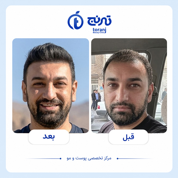 before after hair transplant clinic toranj 3