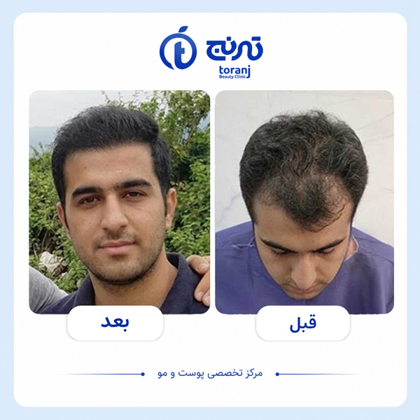 before after hair transplant clinic toranj 4