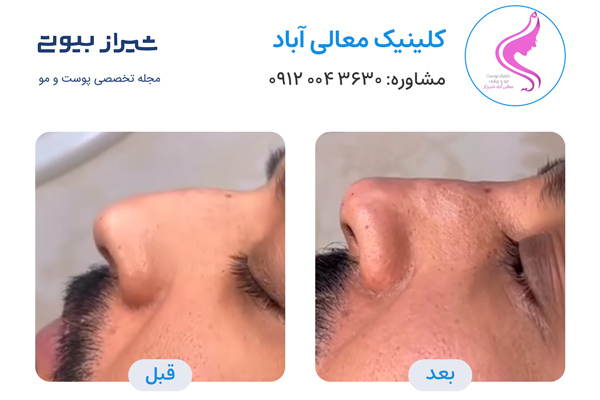 لیفت بینی در شیراز - کلینیک معالی آباد