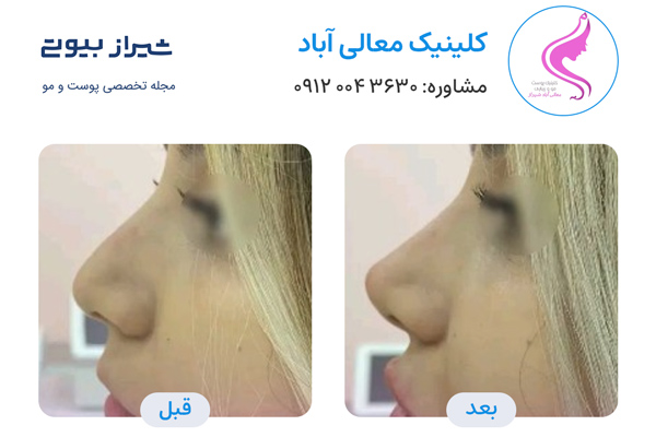 لیفت بینی در شیراز - کلینیک معالی آباد
