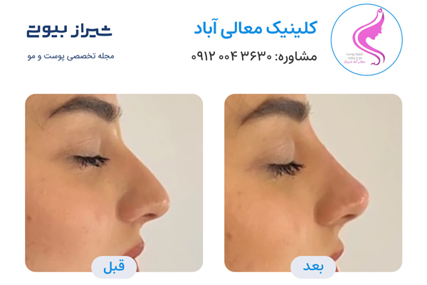 لیفت بینی در شیراز - کلینیک معالی آباد