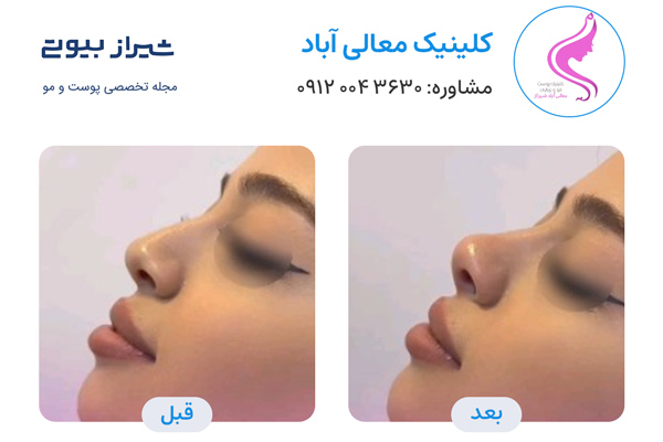 لیفت بینی در شیراز - کلینیک معالی آباد