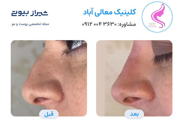 لیفت بینی در شیراز - کلینیک معالی آباد