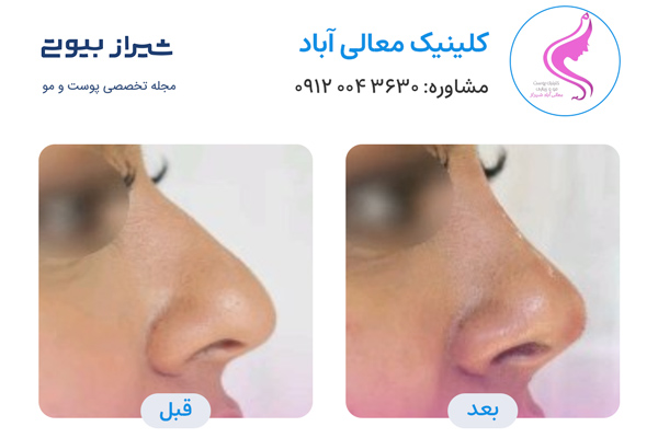 لیفت بینی در شیراز - کلینیک معالی آباد