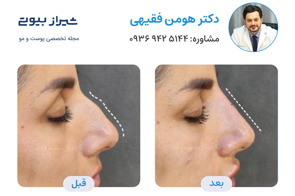 لیفت بینی در شیراز - دکتر هومن فقیهی