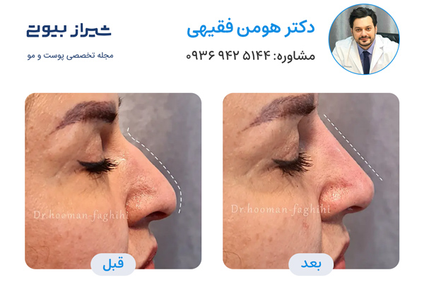 لیفت بینی در شیراز - دکتر هومن فقیهی